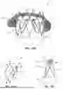 Fig. 19 - Heart Valve Replacement