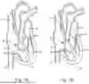 Fig. 02 - SYSTEMS, METHODS AND DEVICES FOR TREATING TRICUSPID INSUFFICIENCY