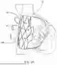 Fig. 05 - SYSTEMS, METHODS AND DEVICES FOR TREATING TRICUSPID INSUFFICIENCY