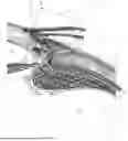 Fig. 01 - Method for positioning an interpositional ophthalmological implant at a distance from the limbus