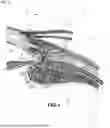 Fig. 02 - Method for positioning an interpositional ophthalmological implant at a distance from the limbus
