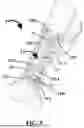 Fig. 04 - TAMPON INSERTION DEVICE AND METHOD
