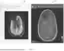 Fig. 09 - SYSTEMS, METHODS, AND COMPUTER READABLE MEDIA FOR PARAMETRIC FDG PET QUANTIFICATION, SEGMENTATION AND CLASSIFICATION OF ABNORMALITIES