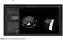 Fig. 39 - HISTOTRIPSY SYSTEMS AND ASSOCIATED METHODS INCLUDING USER INTERFACES AND WORKFLOWS FOR TREATMENT PLANNING AND THERAPY