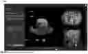 Fig. 73 - HISTOTRIPSY SYSTEMS AND ASSOCIATED METHODS INCLUDING USER INTERFACES AND WORKFLOWS FOR TREATMENT PLANNING AND THERAPY
