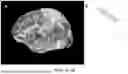 Fig. 04 - PRECISION FUNCTIONAL MAPPING (PFM) TO PERSONALIZE NEUROMODULATION IN PSYCHIATRIC AND NEUROLOGICAL APPLICATIONS