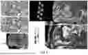 Fig. 06 - PRECISION FUNCTIONAL MAPPING (PFM) TO PERSONALIZE NEUROMODULATION IN PSYCHIATRIC AND NEUROLOGICAL APPLICATIONS