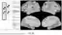 Fig. 08 - PRECISION FUNCTIONAL MAPPING (PFM) TO PERSONALIZE NEUROMODULATION IN PSYCHIATRIC AND NEUROLOGICAL APPLICATIONS