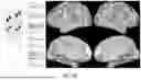 Fig. 09 - PRECISION FUNCTIONAL MAPPING (PFM) TO PERSONALIZE NEUROMODULATION IN PSYCHIATRIC AND NEUROLOGICAL APPLICATIONS