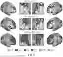 Fig. 11 - PRECISION FUNCTIONAL MAPPING (PFM) TO PERSONALIZE NEUROMODULATION IN PSYCHIATRIC AND NEUROLOGICAL APPLICATIONS