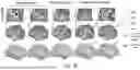 Fig. 14 - PRECISION FUNCTIONAL MAPPING (PFM) TO PERSONALIZE NEUROMODULATION IN PSYCHIATRIC AND NEUROLOGICAL APPLICATIONS