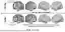 Fig. 16 - PRECISION FUNCTIONAL MAPPING (PFM) TO PERSONALIZE NEUROMODULATION IN PSYCHIATRIC AND NEUROLOGICAL APPLICATIONS