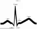 Fig. 02 - METHOD, PROGRAM, AND DEVICE FOR DIAGNOSING THYROID DYSFUNCTION ON BASIS OF ELECTROCARDIOGRAM