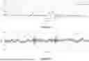 Fig. 20 - SYSTEMS AND METHODS FOR MATERNAL UTERINE ACTIVITY DETECTION