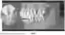 Fig. 09 - METHODS AND APPARATUSES FOR HYBRID CONE BEAM COMPUTED TOMOGRAPHIC AND INTRAORAL SCAN IMAGE MODELING