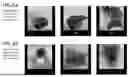 Fig. 07 - SYSTEMS AND METHODS FOR STOOL CHARACTERIZATION AS NON-INVASIVE MEASURES OF DISEASE ACTIVITY
