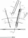 Fig. 02 - SYSTEMS, DEVICES, AND METHODS FOR CLOSING AN ABDOMINAL WALL DEFECT