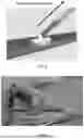 Fig. 03 - IMPLANTABLE DEVICES, SYSTEMS AND METHODS FOR CLOSING APERTURE