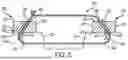 Fig. 06 - RETENTION SUTURE ASSEMBLY