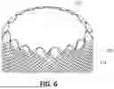 Fig. 08 - DEVICES FOR TREATMENT OF VASCULAR DEFECTS