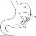 Fig. 01 - MAGNETIC DEVICES AND METHODS FOR MAGNETICALLY CLAMPING A PORTION OF A HOLLOW ORGAN OF THE DIGESTIVE TRACT