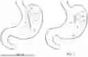 Fig. 06 - MAGNETIC DEVICES AND METHODS FOR MAGNETICALLY CLAMPING A PORTION OF A HOLLOW ORGAN OF THE DIGESTIVE TRACT
