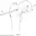 Fig. 02 - DELIVERY SYSTEM THROUGH A MEDICAL DEVICE