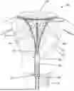 Fig. 01 - ENDOMETRIAL ABLATION METHOD