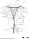 Fig. 11 - ENDOMETRIAL ABLATION METHOD