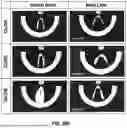 Fig. 28 - KITS FOR SURGICAL REPAIR OF SOFT TISSUE DEFECTS AND COMPONENTS, PACKAGING, AND METHODS OF USE THEREOF