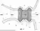 Fig. 04 - TRANSLUMINAL STENTS AND RELATED METHODS
