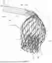 Fig. 02 - IMPLANT DELIVERY