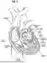 Fig. 02 - SURGICAL HEART VALVES