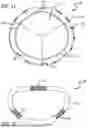 Fig. 08 - Annuloplasty Ring For Receiving A Replacement Valve