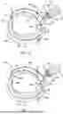 Fig. 03 - TRANSCATHETER ANNULOPLASTY LOCKING SYSTEMS, DEVICES AND METHODS