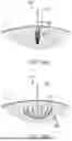 Fig. 16 - TRANSCATHETER ANNULOPLASTY LOCKING SYSTEMS, DEVICES AND METHODS