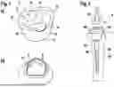 Fig. 02 - Sleeve augment device for an articulated joint
