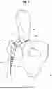 Fig. 03 - BUFFER FOR FEMORAL HEAD AND NECK EXCISION