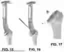 Fig. 09 - SYSTEMS FOR REVERSE SHOULDER IMPLANTS