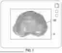 Fig. 06 - Method and Apparatus for Reducing Human Vertebral Body Subsidence Using Variable Surface Area Interbody Cages Correlated to Localized Bone Density Measurements