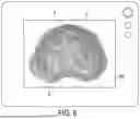 Fig. 07 - Method and Apparatus for Reducing Human Vertebral Body Subsidence Using Variable Surface Area Interbody Cages Correlated to Localized Bone Density Measurements