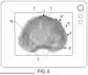 Fig. 09 - Method and Apparatus for Reducing Human Vertebral Body Subsidence Using Variable Surface Area Interbody Cages Correlated to Localized Bone Density Measurements