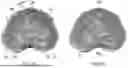 Fig. 22 - Method and Apparatus for Reducing Human Vertebral Body Subsidence Using Variable Surface Area Interbody Cages Correlated to Localized Bone Density Measurements