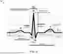 Fig. 07 - PREDICTING TRANSIENT ISCHEMIC EVENTS USING ECG DATA