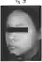 Fig. 11 - COMPOSITIONS USEFUL FOR IMPROVING THE APPEARANCE OF SKIN AND METHODS OF USE THEREOF