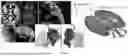 Fig. 08 - METHODS FOR VECTOR-BASED TARGETING OF THE HUMAN CENTRAL THALAMUS TO GUIDE DEEP BRAIN STIMULATION AND DEVICES THEREFOR
