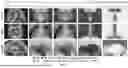 Fig. 09 - METHODS FOR VECTOR-BASED TARGETING OF THE HUMAN CENTRAL THALAMUS TO GUIDE DEEP BRAIN STIMULATION AND DEVICES THEREFOR