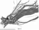 Fig. 13 - METHODS FOR VECTOR-BASED TARGETING OF THE HUMAN CENTRAL THALAMUS TO GUIDE DEEP BRAIN STIMULATION AND DEVICES THEREFOR