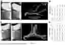 Fig. 19 - METHODS FOR VECTOR-BASED TARGETING OF THE HUMAN CENTRAL THALAMUS TO GUIDE DEEP BRAIN STIMULATION AND DEVICES THEREFOR