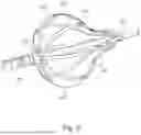 Fig. 07 - DEPLOYABLE STRUCTURES TO PROVIDE ELECTRODES ON THE SURFACE OF AN ENDOSCOPICALLY GUIDED LASER ABLATION CATHETER FOR USE IN ABLATION AND ELECTROPHYSIOLOGICAL MAPPING